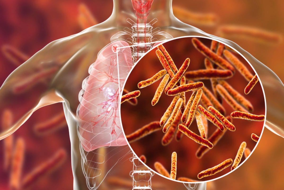 Tuberculosis