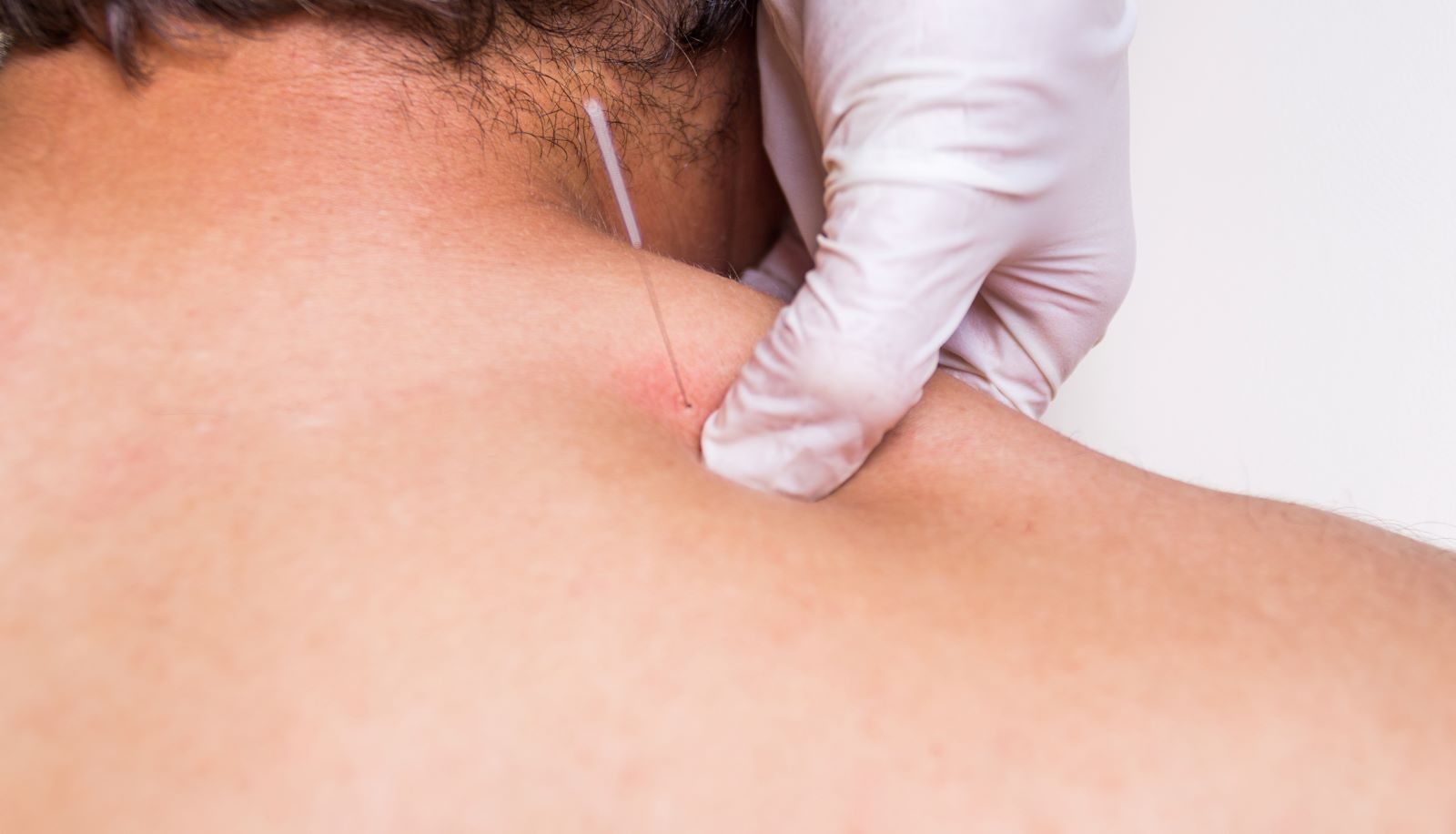Dry Needling