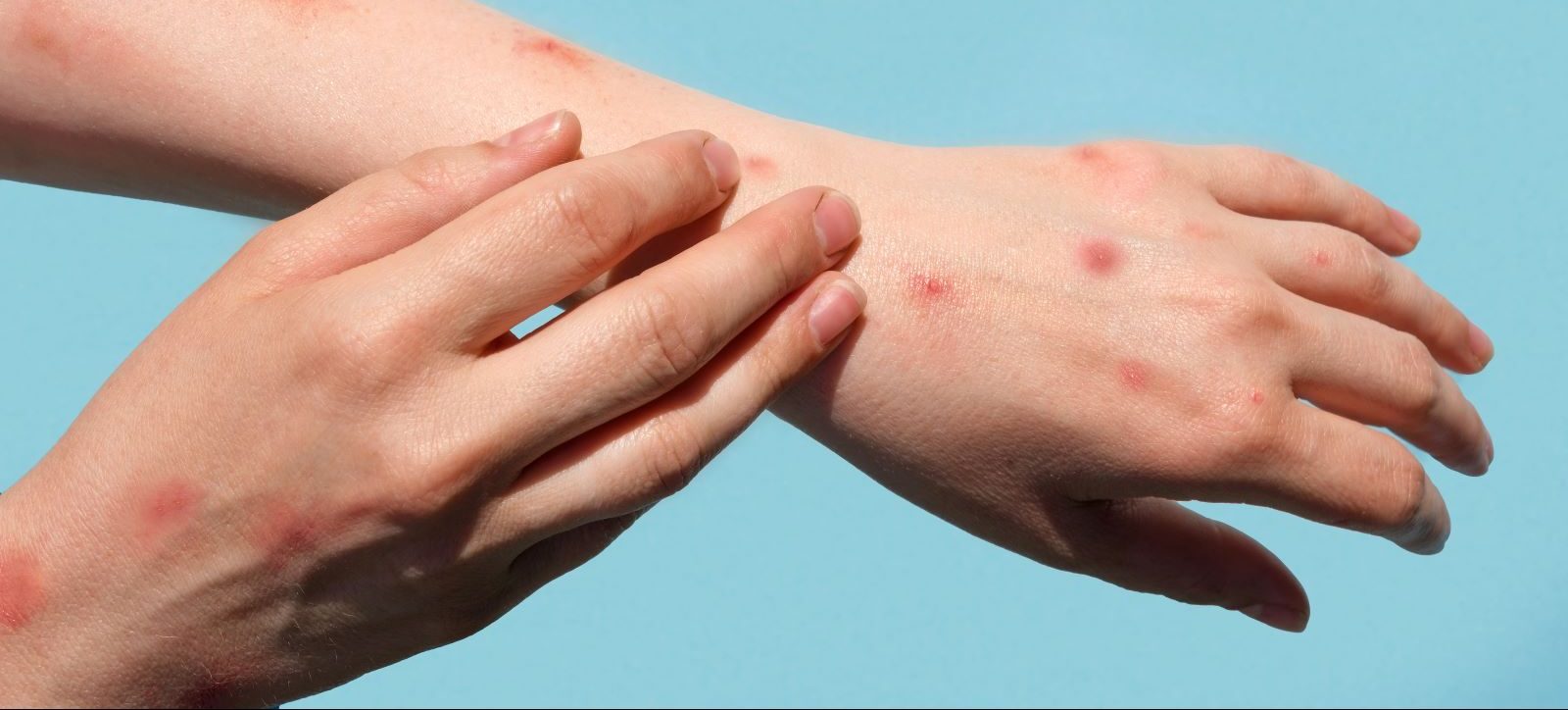 CDC announces level 2 advisory for monkeypox.