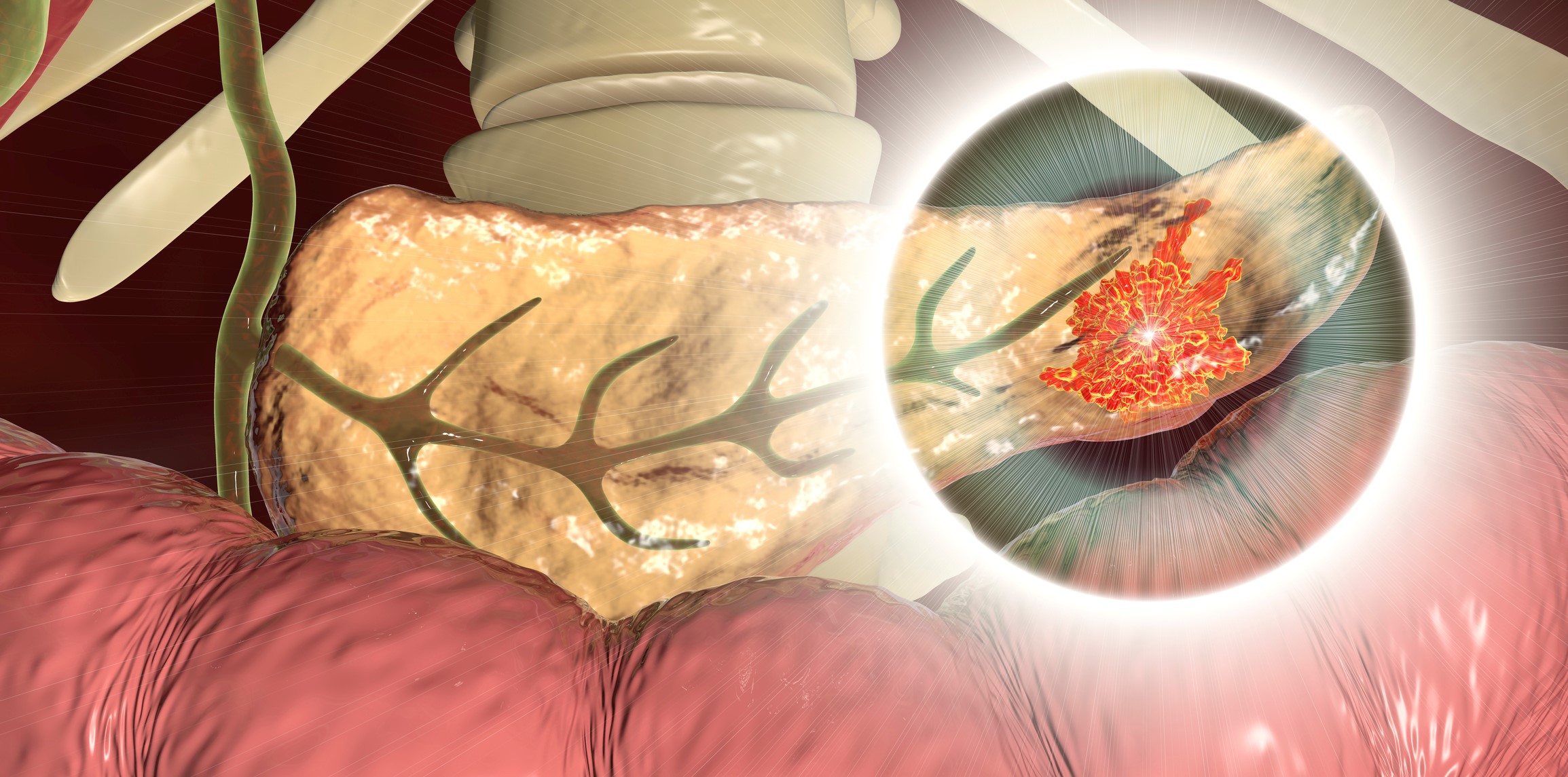 robotic surgery pancreatic cancer