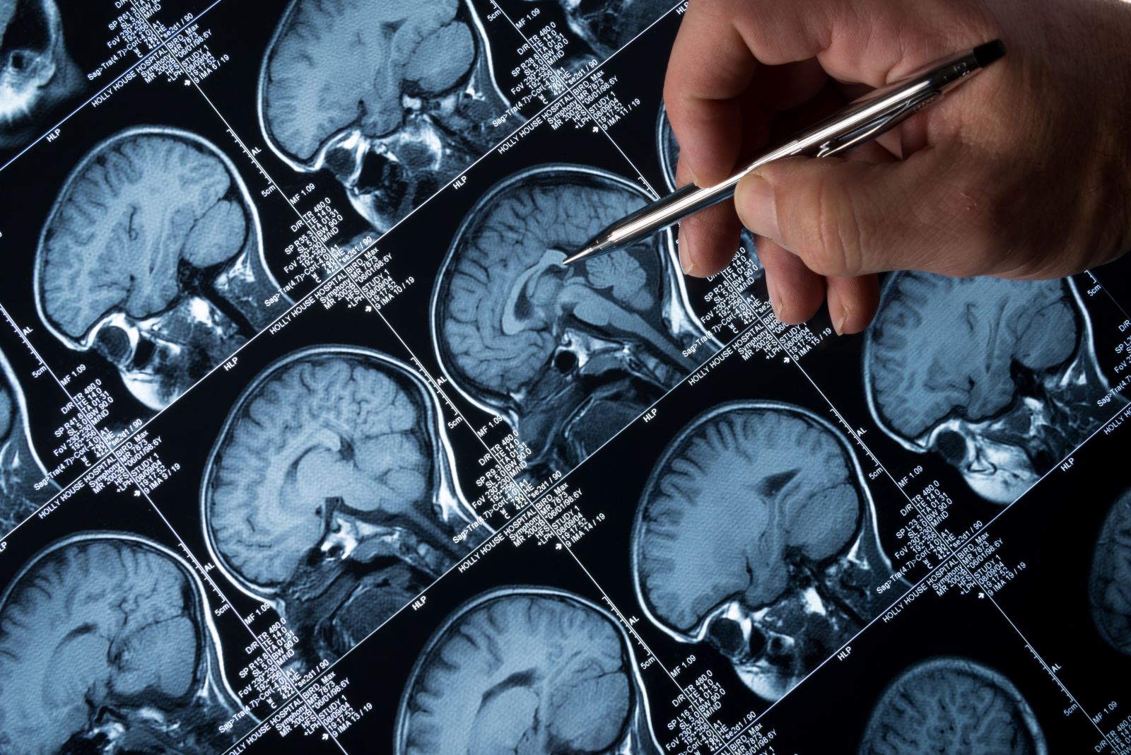 Learn these six surprising facts about seizures and epilepsy, and what to do if someone around you is experiencing one.