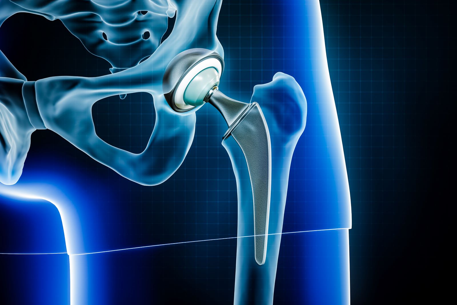 Earlier this month, Shaq had a hip replacement - but is it normal to have a hip replacement at only 51 years old?