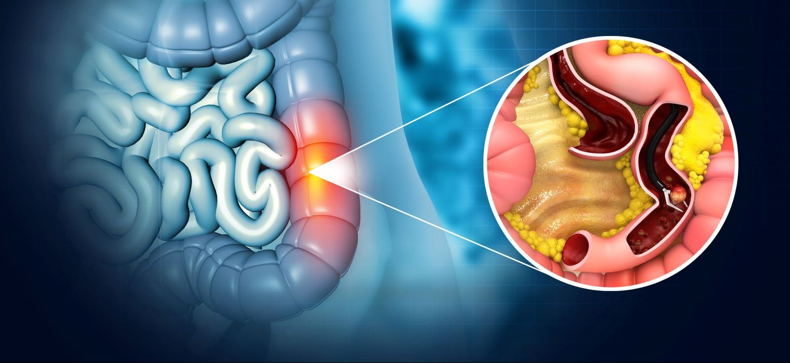 Colon polyps are nothing to worry about. In fact, doctors expect to find them during colonoscopies. But what do they mean?