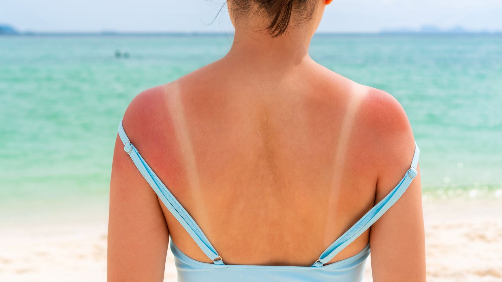 A dermatologist debunks some age-old wisdom about caring for sunburn, and adds tips you might not have thought of.