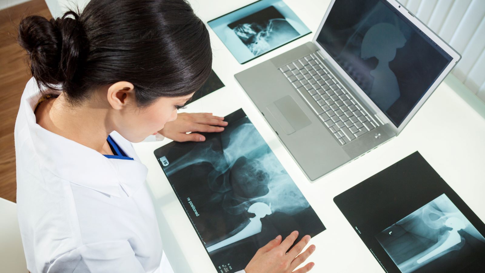 Wondering how long your hip replacement will last? An expert weighs in, and shares how soon you might need a hip revision.