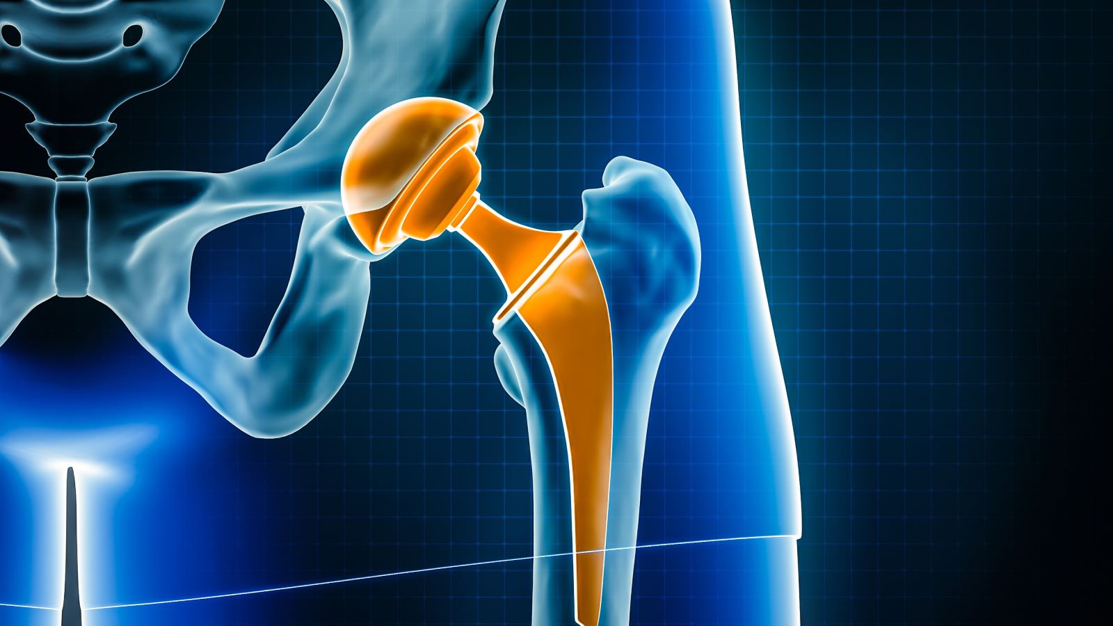 Trying to choose which type of hip replacement to get? This is everything you need to know, according to an orthopedic surgeon.