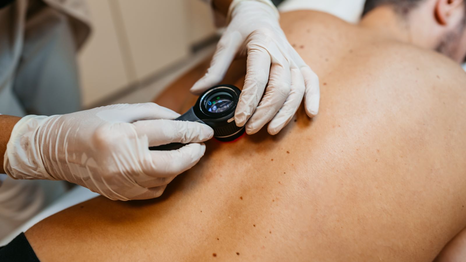 Is the most common location of skin cancer another area where gender matters? We asked a surgical oncologist to weigh in.